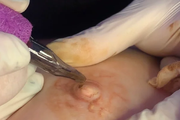 micropigmentaciondeareolas