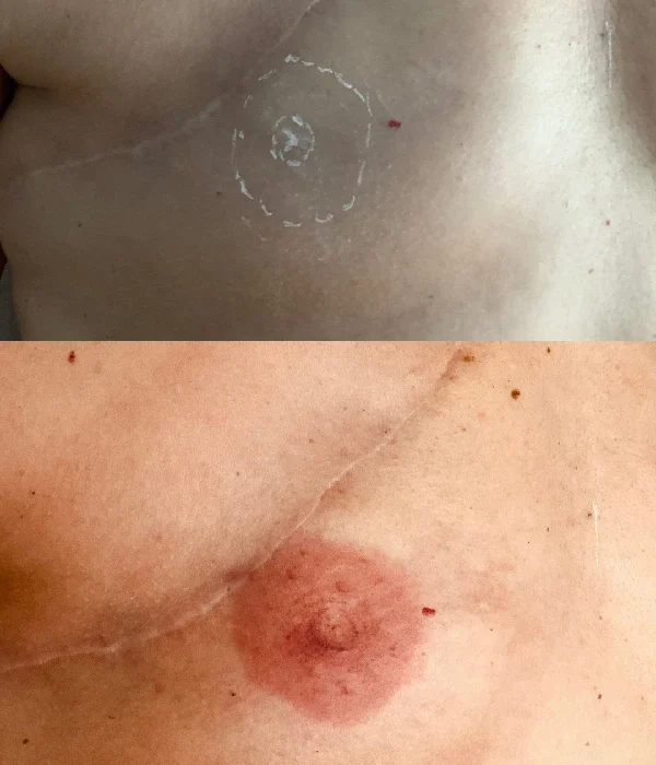 resultados micropgimentacion